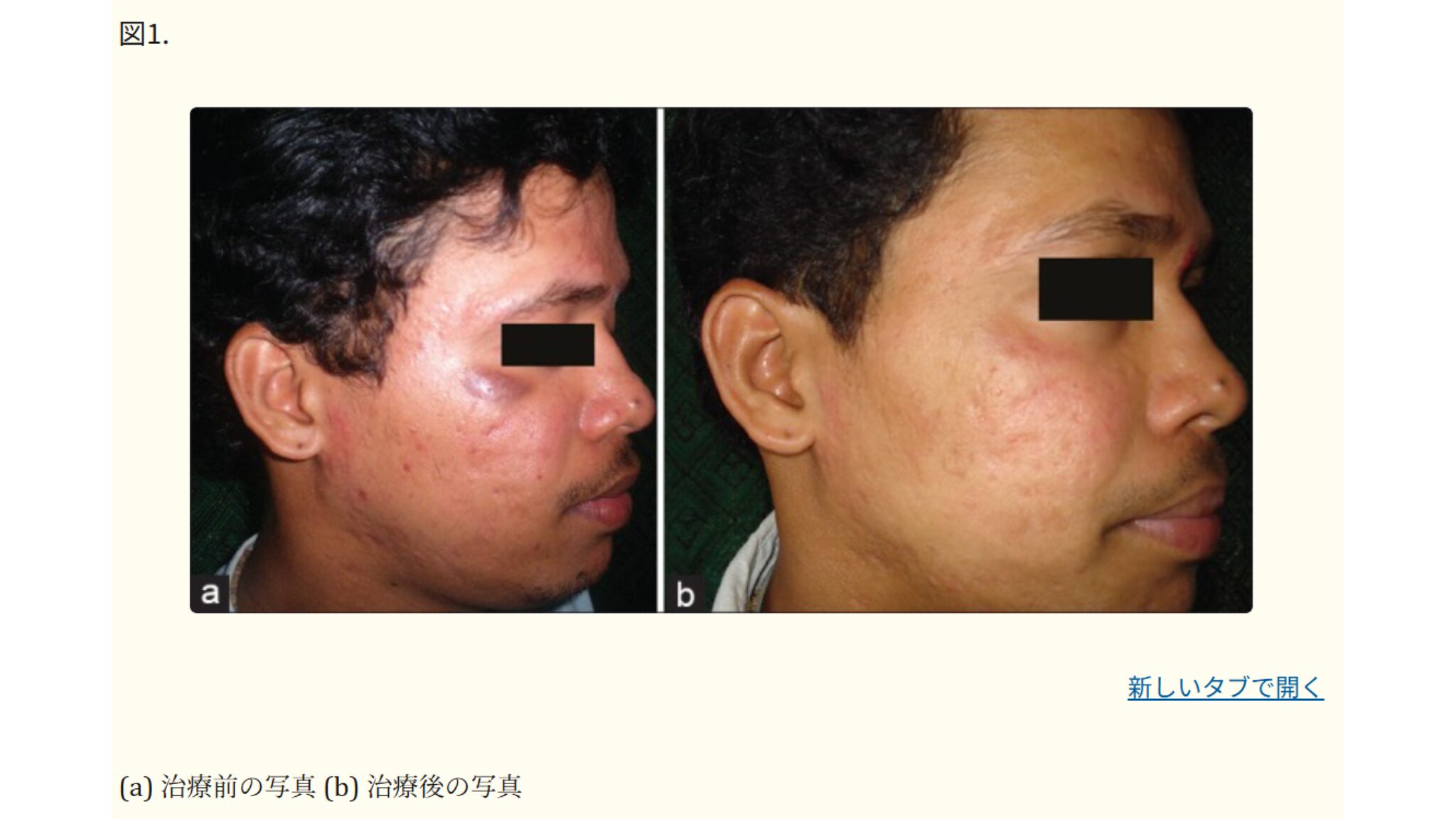 ファザー・ミュラー医科大学皮膚科(インド)で行われたイソトレチノインによるニキビの症状改善例