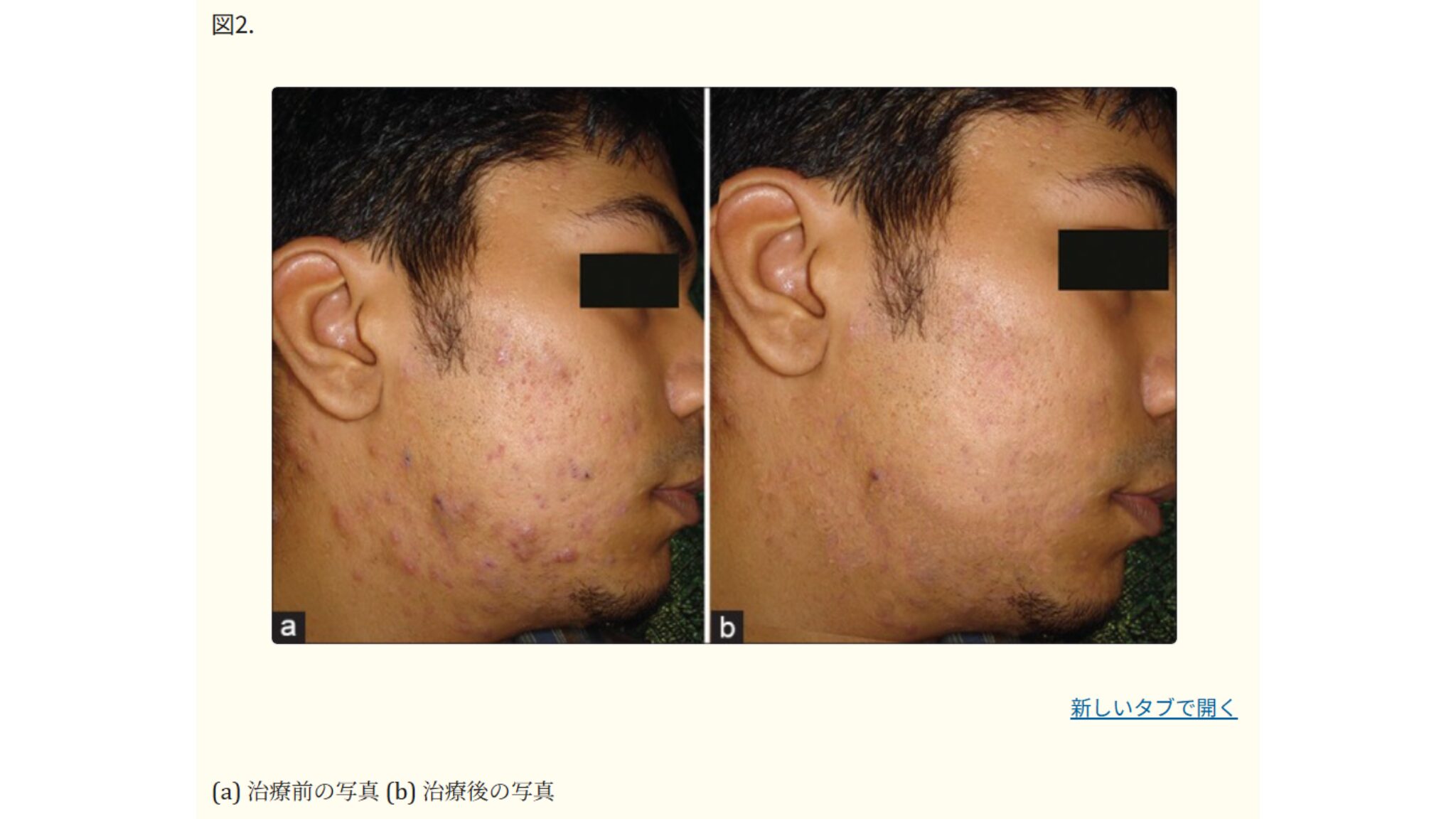 ファザー・ミュラー医科大学皮膚科(インド)で行われたイソトレチノインによるニキビの症状改善例