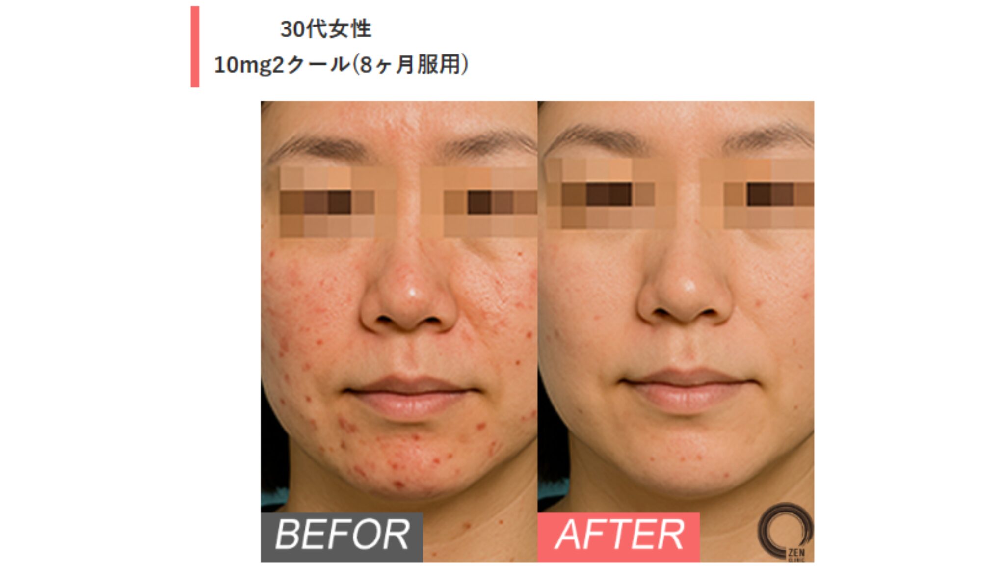 30代女性：赤ニキビがほぼゼロに&顔の皮脂も軽減