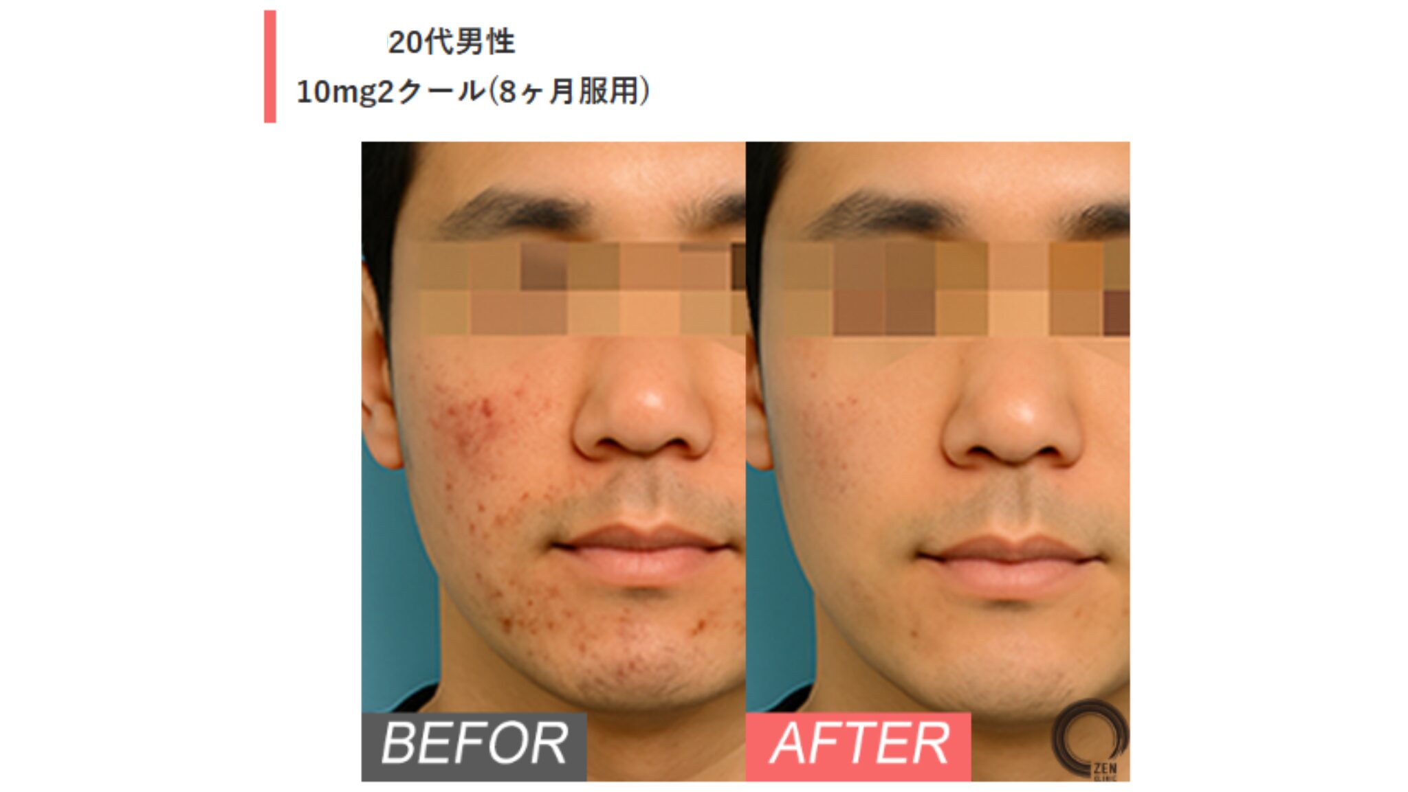 20代男性：炎症の強いニキビや色素沈着も改善