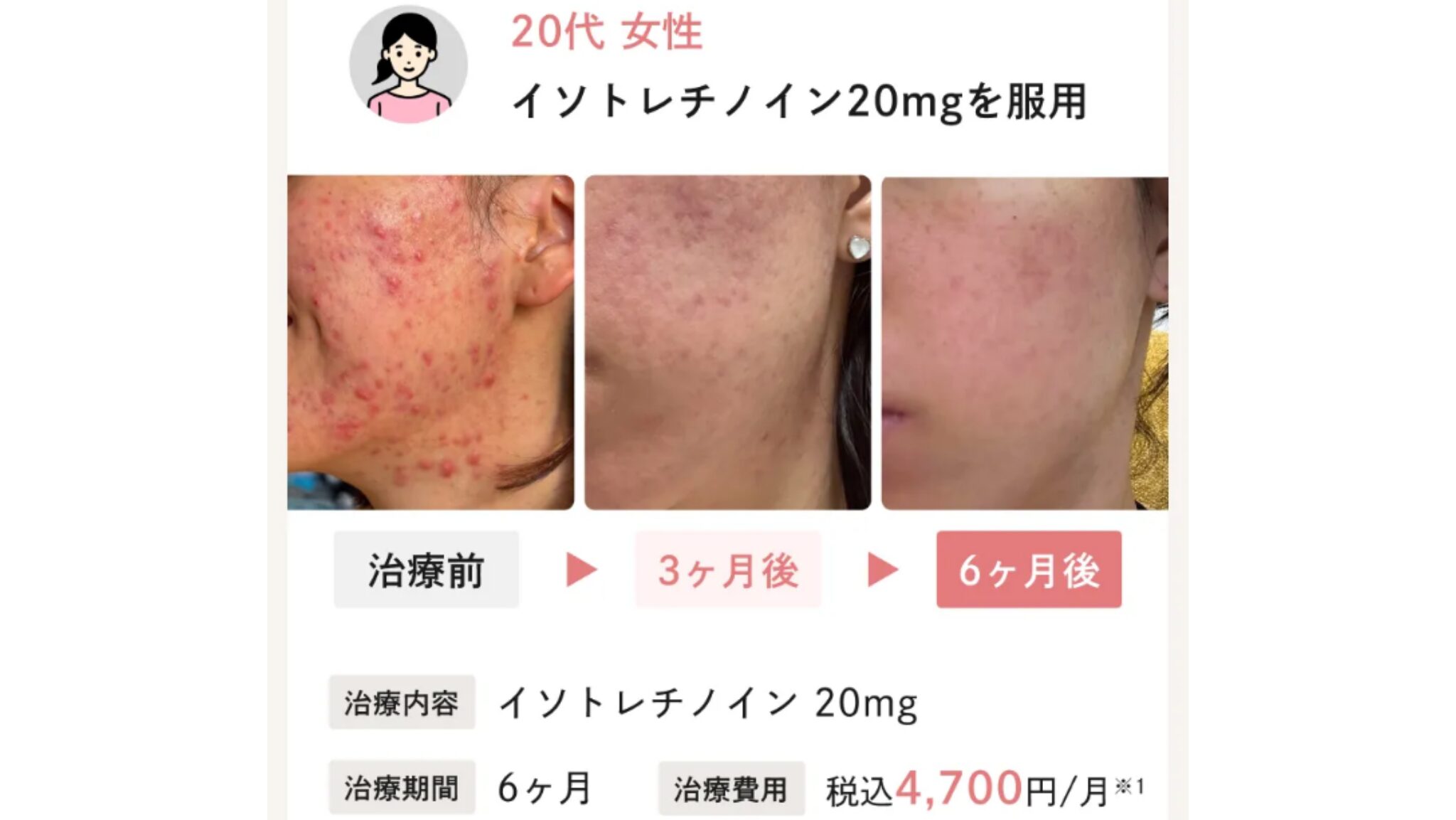 Actually,（アクチュアリー）の症例写真①
