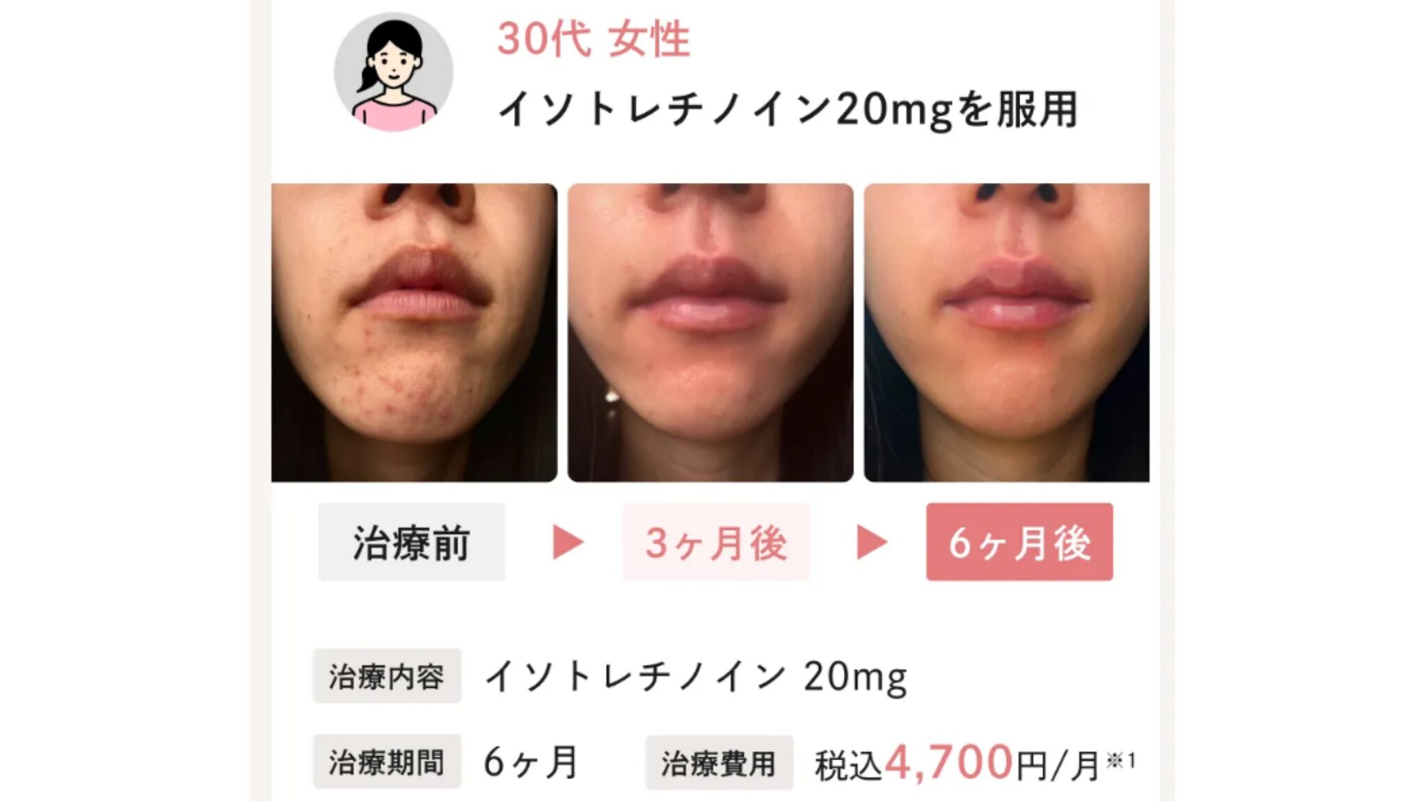 Actually,（アクチュアリー）の症例写真②