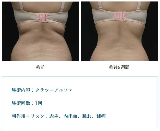 リエートクリニックの脂肪冷却（背中の術前・術後）
