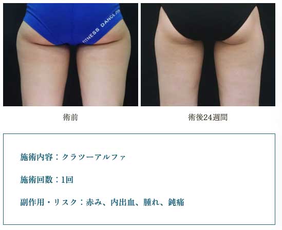 リエートクリニックの脂肪冷却（太ももの術前・術後）