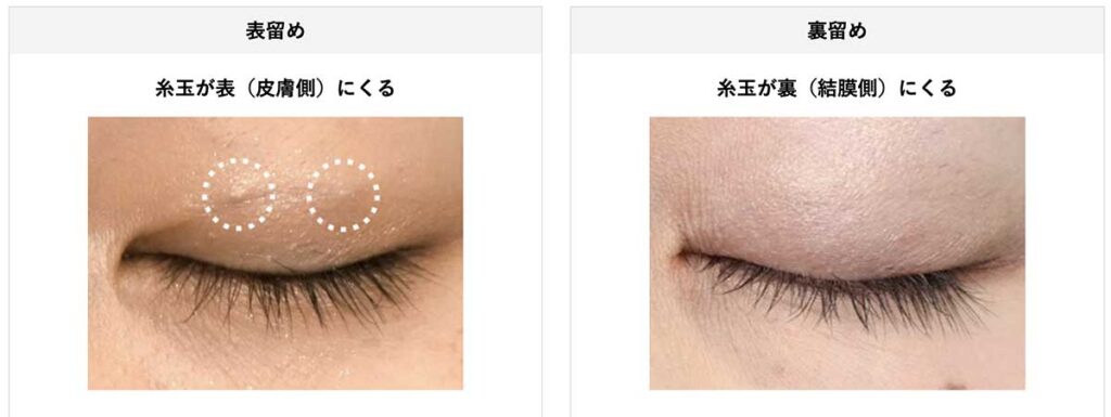 湘南美容クリニック(埋没、裏留め)