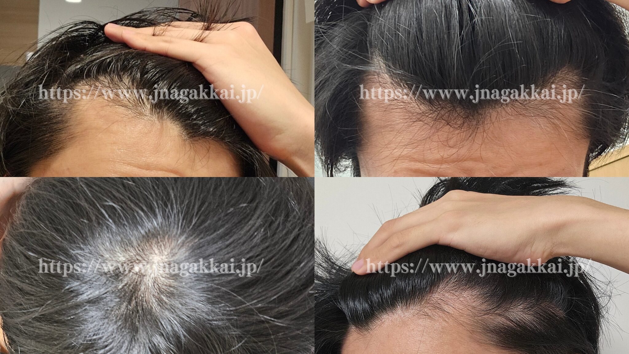 ケイスケの頭部AGA写真