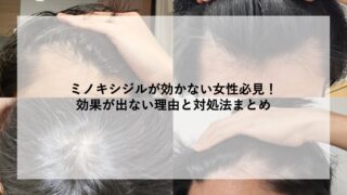 ミノキシジルが効かない女性必見！効果が出ない理由と対処法まとめ 
