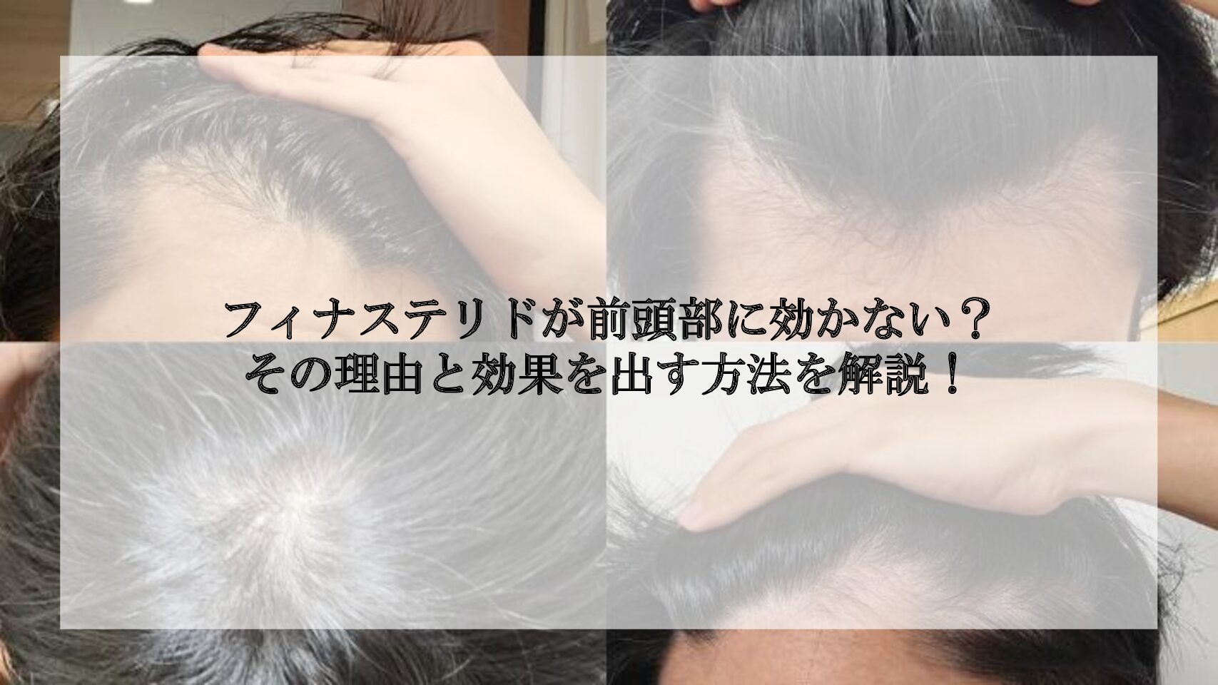 フィナステリドはやばい？副作用の確率と初期脱毛の期間を臨床データから徹底検証