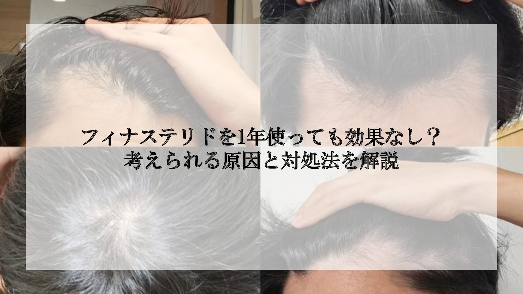フィナステリドを1年使っても効果なし？考えられる原因と対処法を解説 