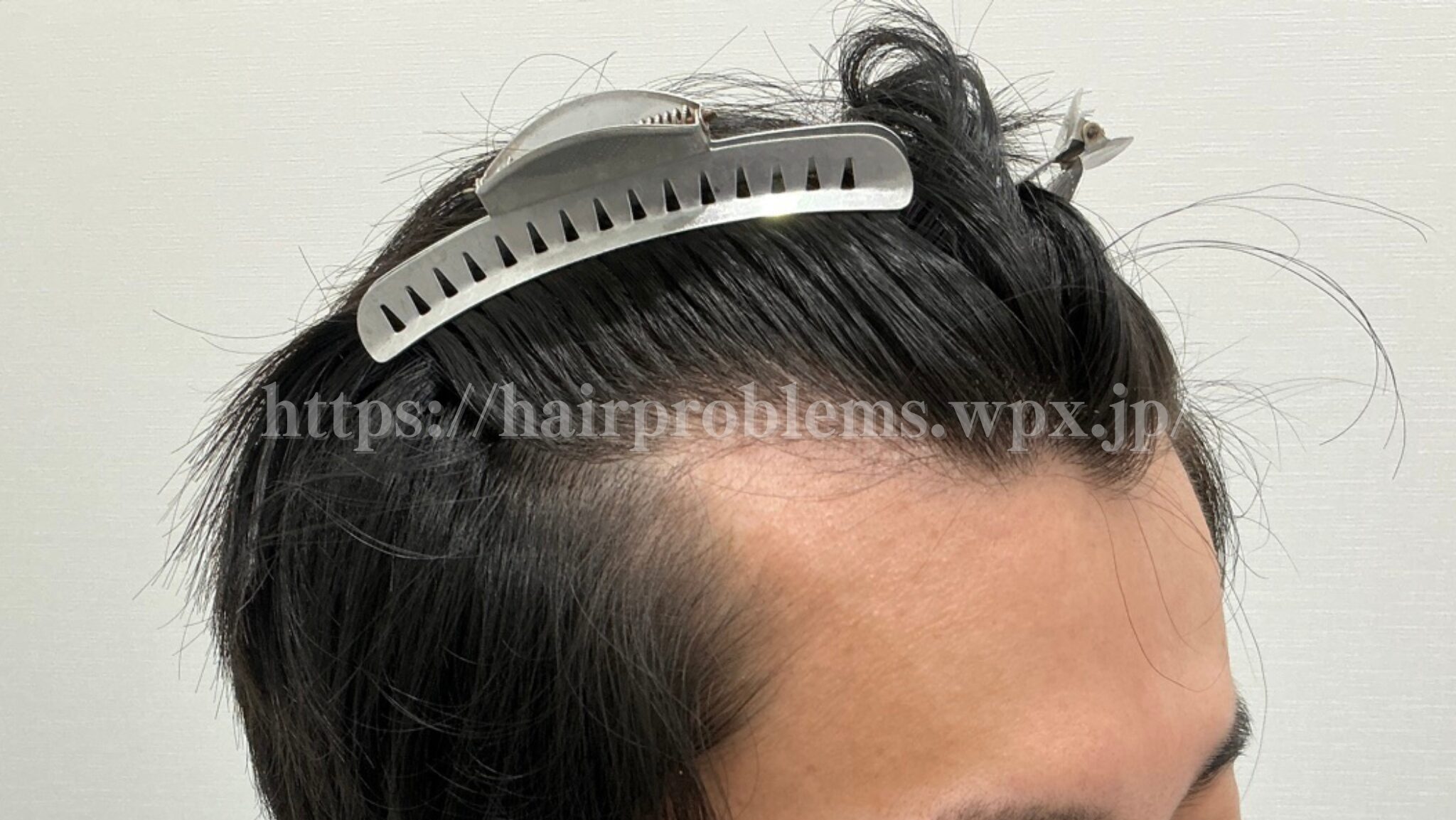 ケイスケの生え際の写真